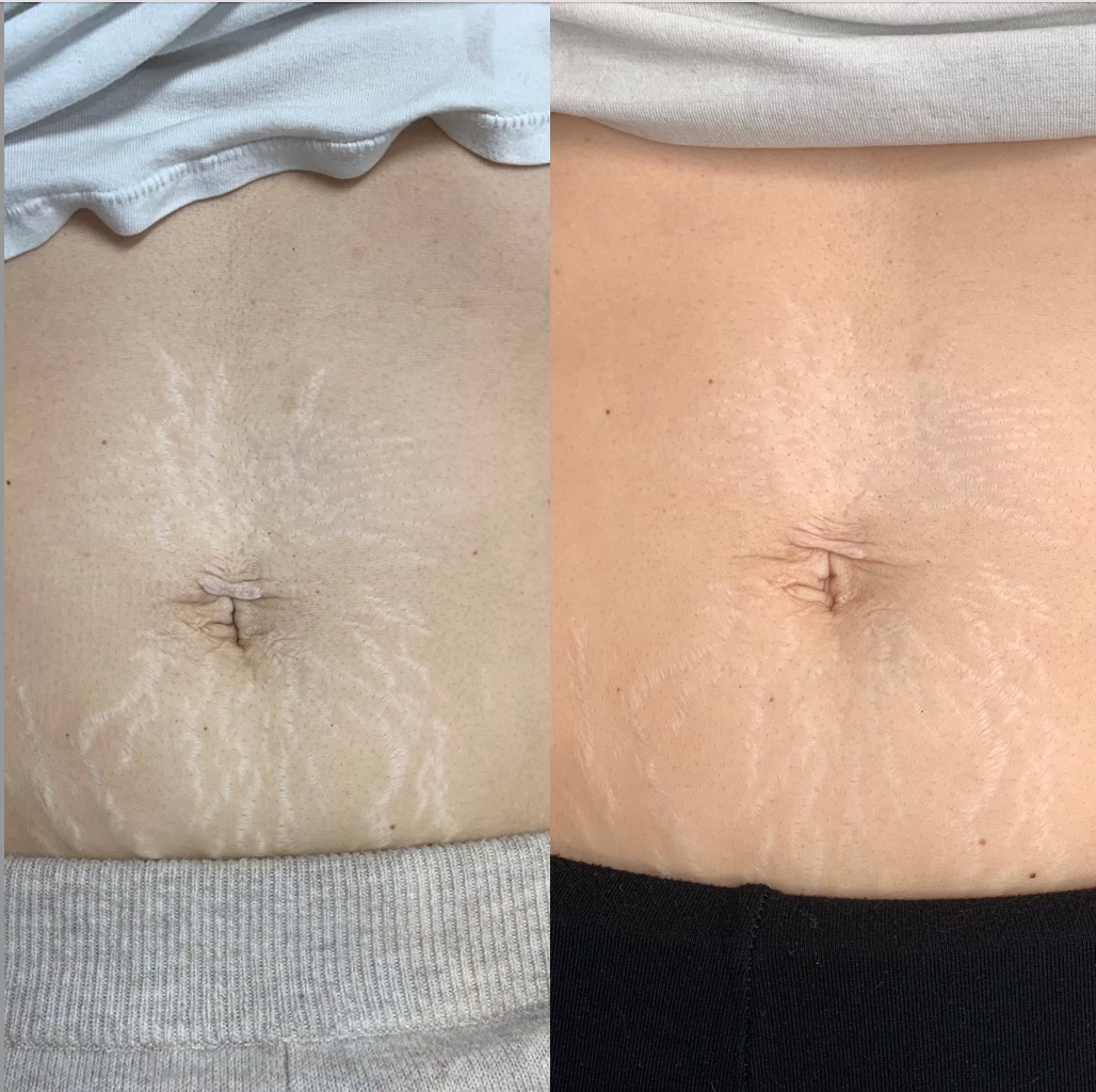 Scar and Stretch Mark Camouflage — Bloom Ink